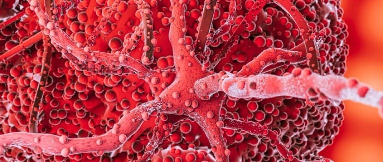 Acute Myeloid Leukemia