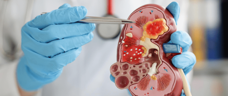Kidney Transplantation