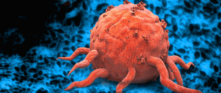 Acute Myeloid Leukemia