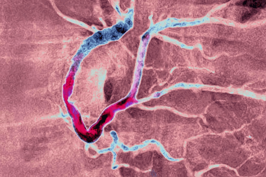 What Is Coronary Artery Disease CAD: 10 Facts