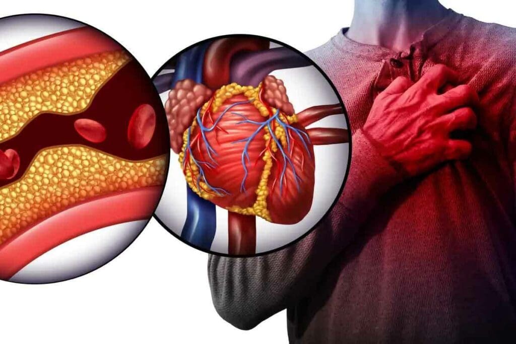 What Is Acute Coronary Artery Thrombus and How Does It Cause Heart Attacks?
